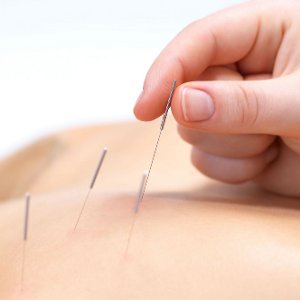 Ce afectiuni pot fi tratate prin acupunctura?