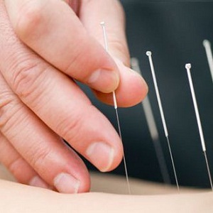 Cum te ajuta acupunctura sa slabesti